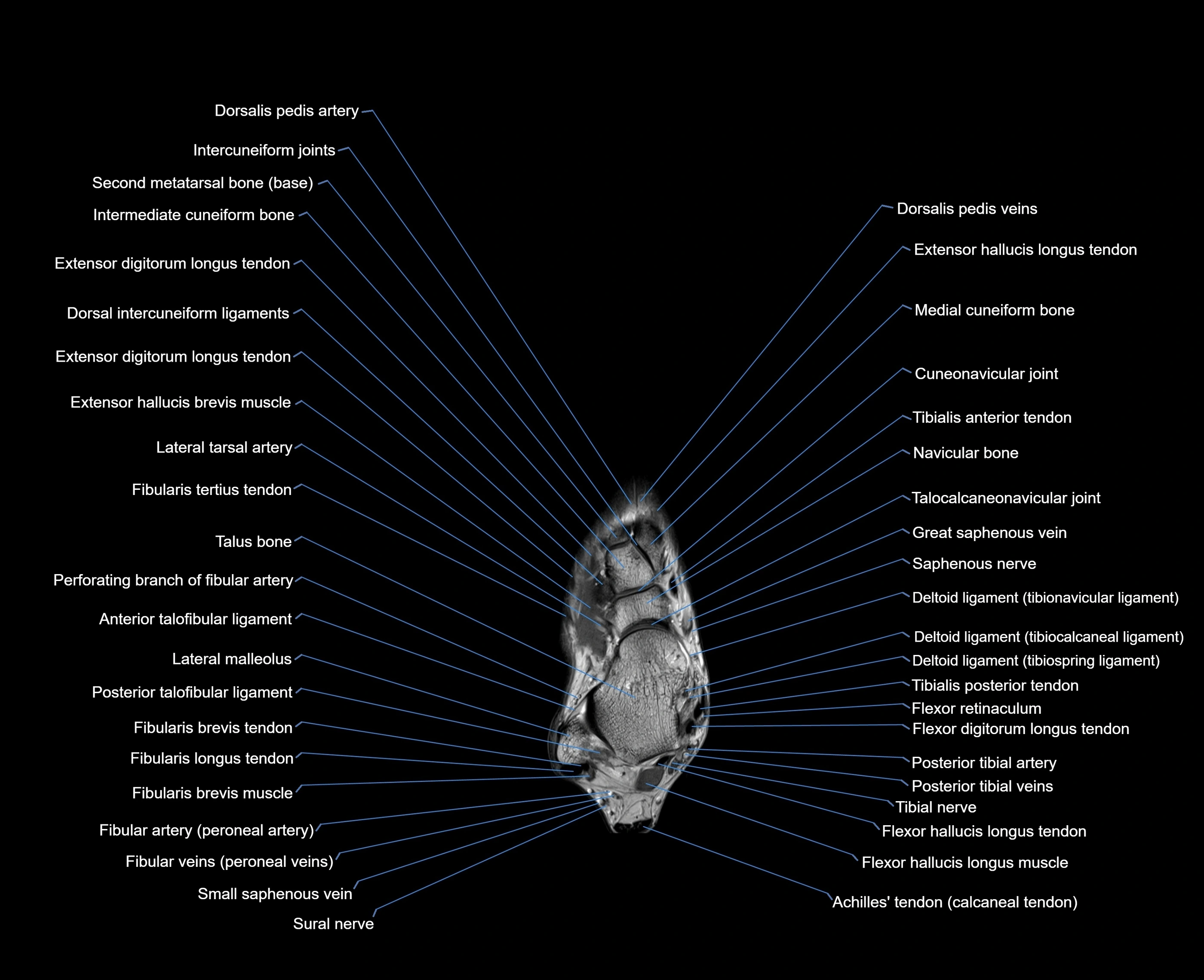 MRI foot coronal cross sectional anatomy 3T  radiology  image-img-00001-00011.webp